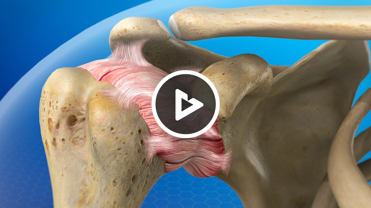 Frozen Shoulder (Adhesive Capsulitis) - Shoulder - The Orthopaedic ...