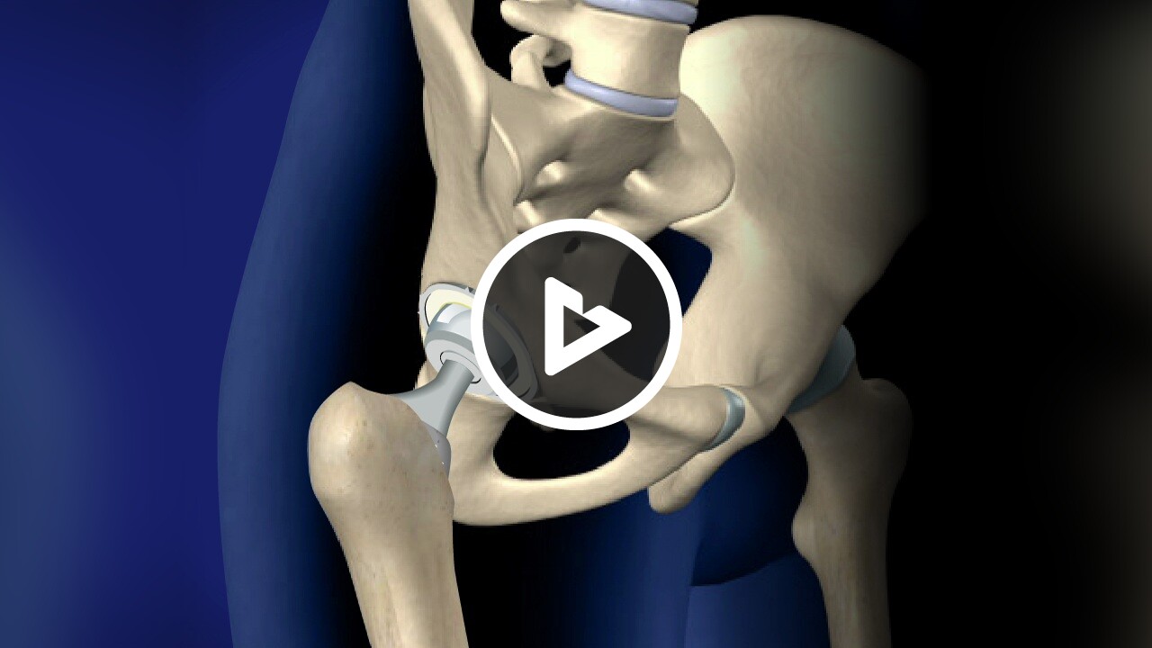 Total Hip Replacement, Anterior Approach - Hip & Upper Thigh - The ...